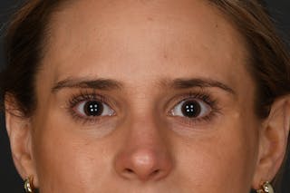 Blepharoplasty Before & After Gallery - Patient 133954 - Image 2