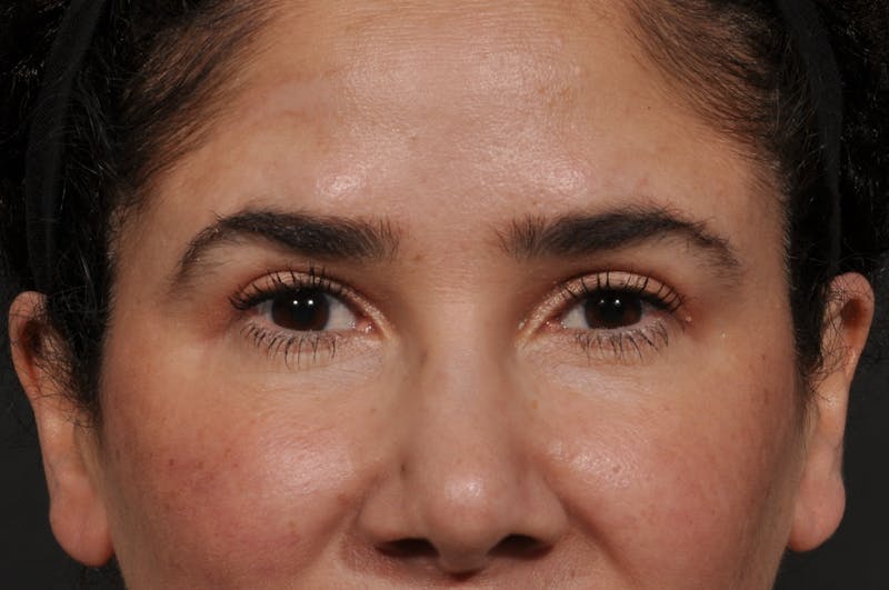 Blepharoplasty Before & After Gallery - Patient 409502 - Image 2