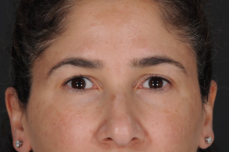 Blepharoplasty Before & After Gallery - Patient 409502 - Image 1