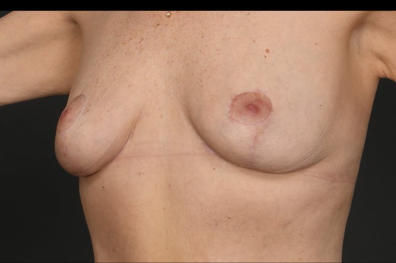 Breast Lift Before & After Gallery - Patient 415008 - Image 4