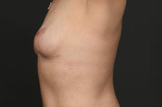 Breast Lift Before & After Gallery - Patient 415008 - Image 6