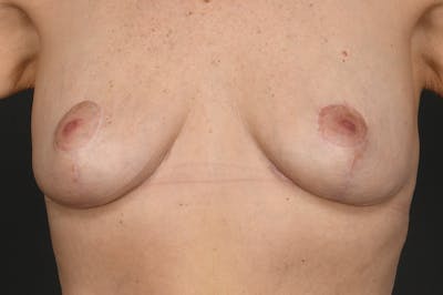 Breast Lift Before & After Gallery - Patient 415008 - Image 2