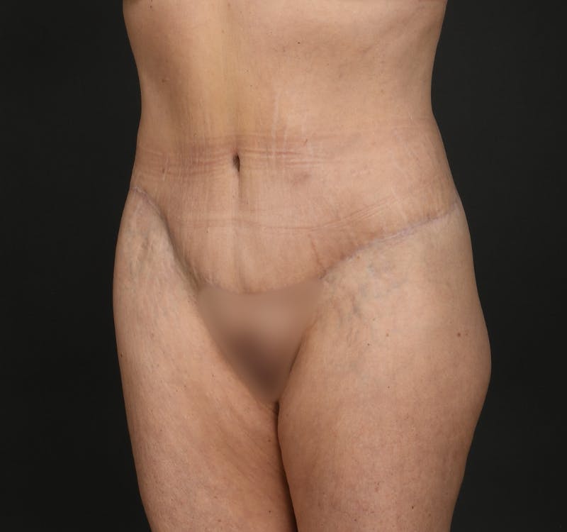Tummy Tuck Before & After Gallery - Patient 427024 - Image 4