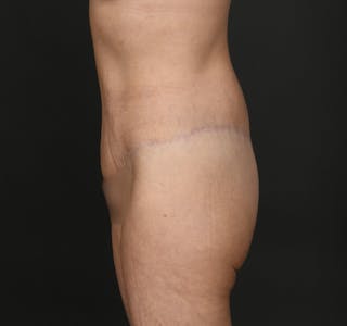 Tummy Tuck Before & After Gallery - Patient 427024 - Image 6