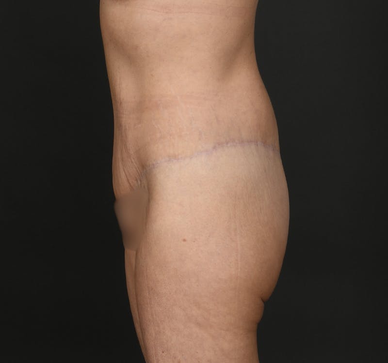 Tummy Tuck Before & After Gallery - Patient 427024 - Image 6