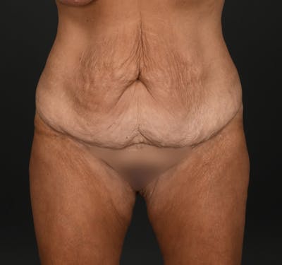 Tummy Tuck Before & After Gallery - Patient 427024 - Image 1