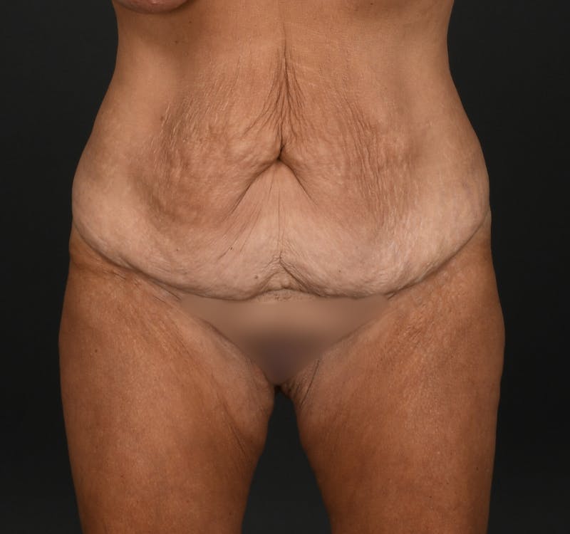 Tummy Tuck Before & After Gallery - Patient 427024 - Image 1