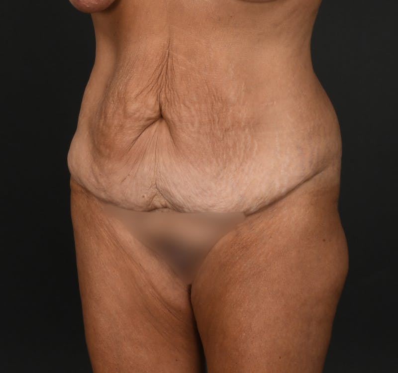 Tummy Tuck Before & After Gallery - Patient 427024 - Image 3