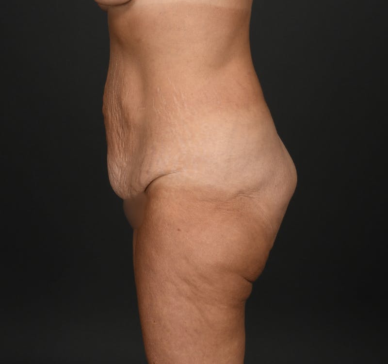 Tummy Tuck Before & After Gallery - Patient 427024 - Image 5