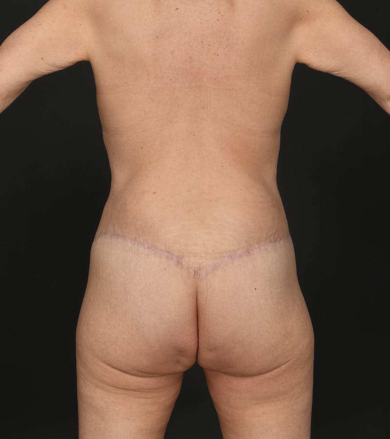 Mommy Makeover Before & After Gallery - Patient 404617 - Image 10