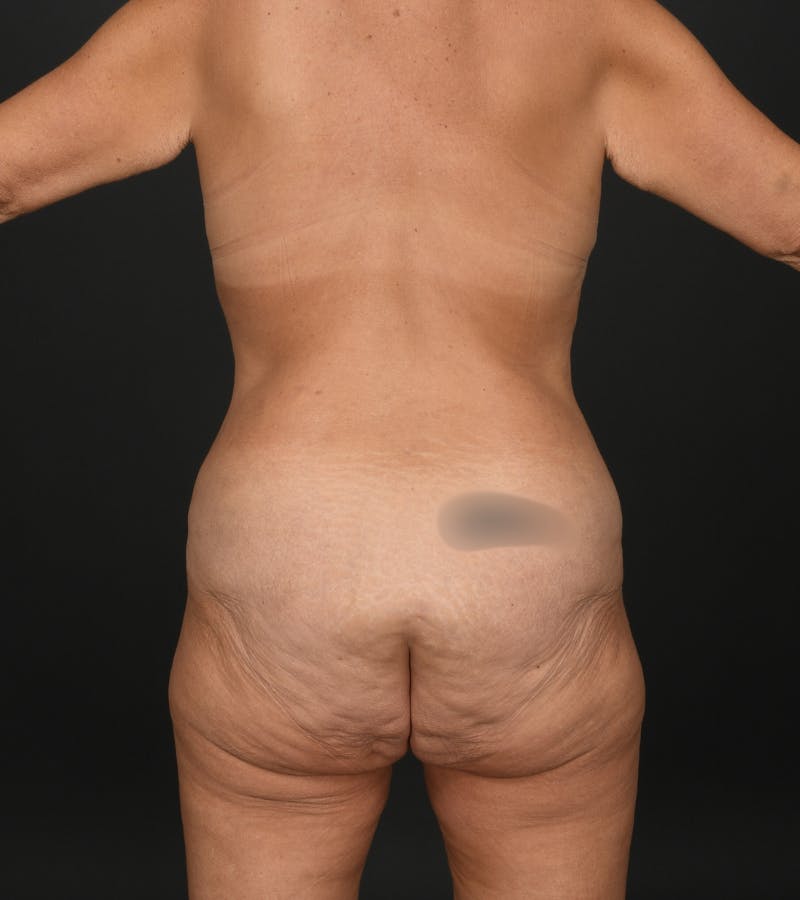 Mommy Makeover Before & After Gallery - Patient 404617 - Image 9