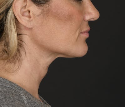 Neck Lift Before & After Gallery - Patient 229053 - Image 1