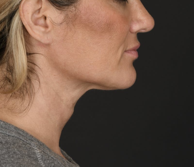 Neck Lift Before & After Gallery - Patient 229053 - Image 1
