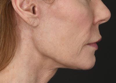 Neck Lift Before & After Gallery - Patient 200880 - Image 2