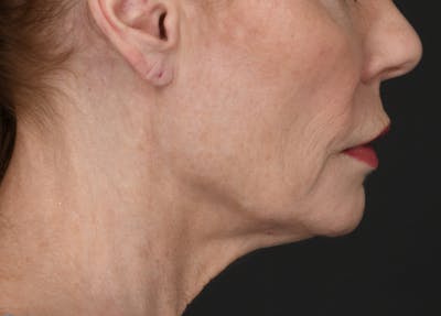 Neck Lift Before & After Gallery - Patient 200880 - Image 1