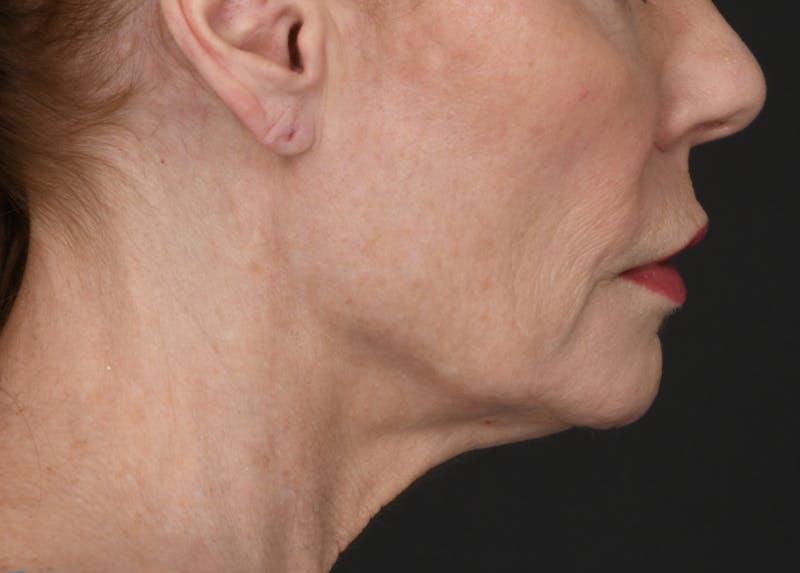 Neck Lift Before & After Gallery - Patient 200880 - Image 1