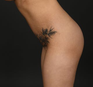 Tummy Tuck Before & After Gallery - Patient 297732 - Image 8