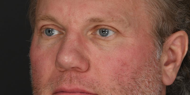 Blepharoplasty Before & After Gallery - Patient 103667 - Image 6