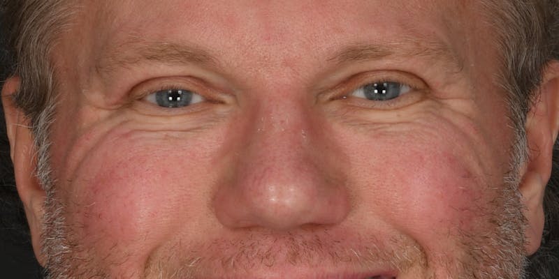 Blepharoplasty Before & After Gallery - Patient 103667 - Image 2
