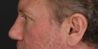 Blepharoplasty Before & After Gallery - Patient 103667 - Image 4