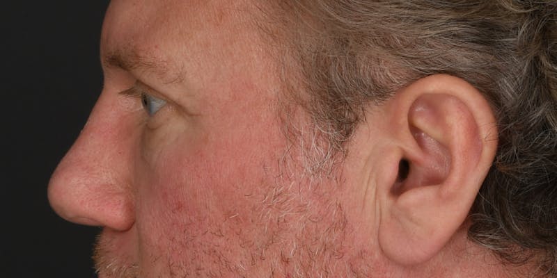 Blepharoplasty Before & After Gallery - Patient 103667 - Image 4