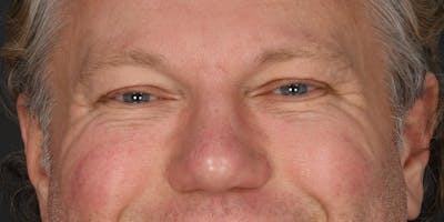 Blepharoplasty Before & After Gallery - Patient 103667 - Image 1