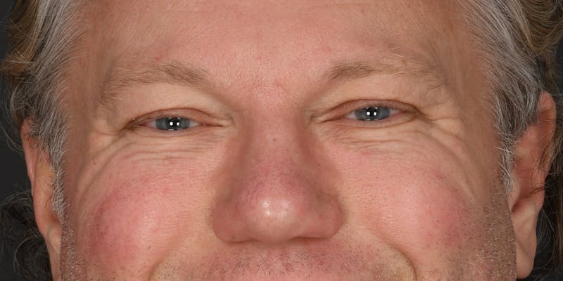 Blepharoplasty Before & After Gallery - Patient 103667 - Image 1
