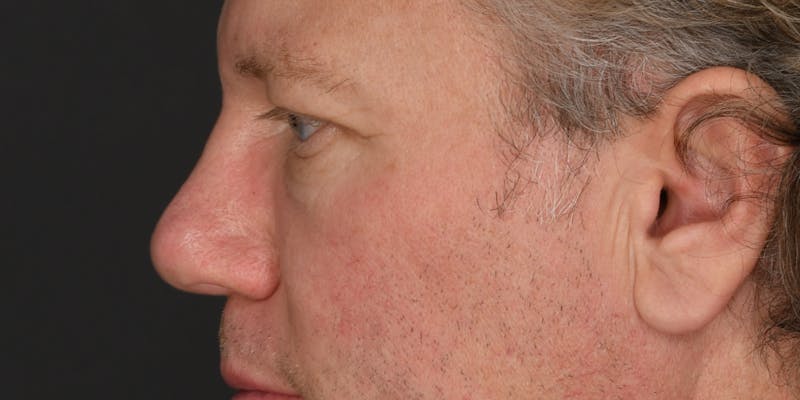 Blepharoplasty Before & After Gallery - Patient 103667 - Image 3