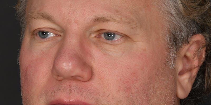 Blepharoplasty Before & After Gallery - Patient 103667 - Image 5