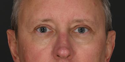 Blepharoplasty Before & After Gallery - Patient 128662 - Image 2