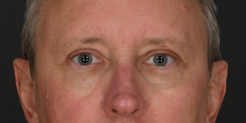 Blepharoplasty Before & After Gallery - Patient 128662 - Image 2