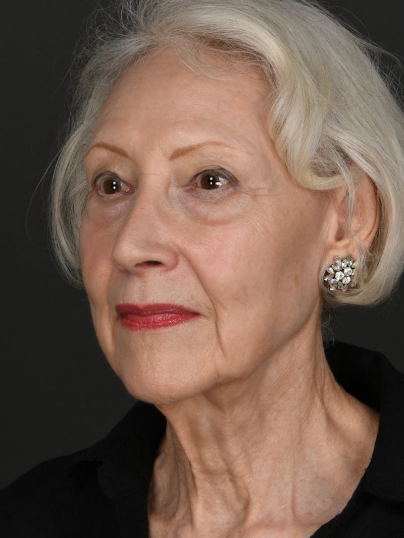 Facelift Before & After Gallery - Patient 285668 - Image 1