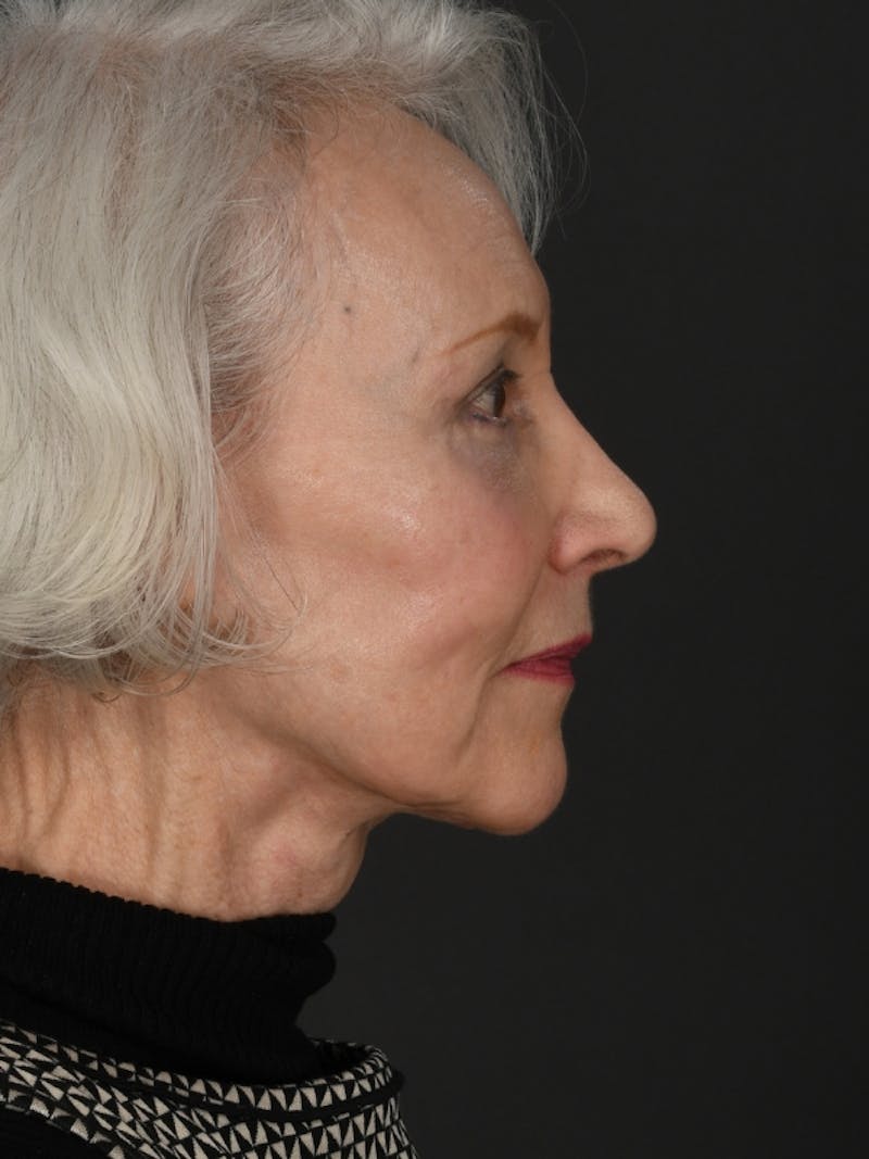 Facelift Before & After Gallery - Patient 285668 - Image 6