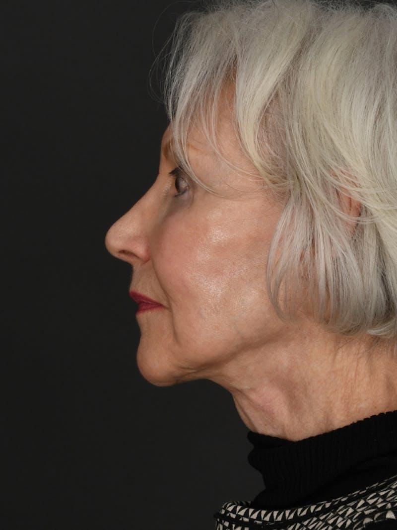 Facelift Before & After Gallery - Patient 285668 - Image 4