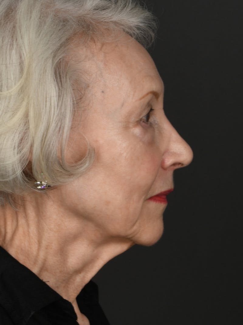 Facelift Before & After Gallery - Patient 285668 - Image 5