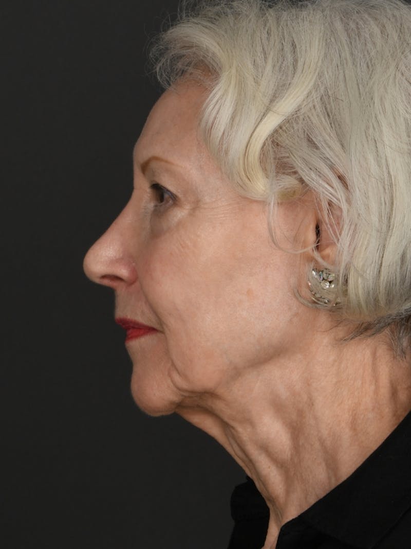 Facelift Before & After Gallery - Patient 285668 - Image 3