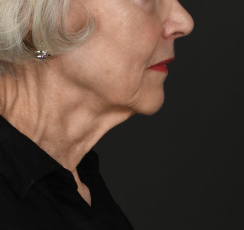 Neck Lift Before & After Gallery - Patient 116979 - Image 1