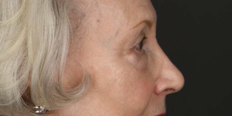 Blepharoplasty Before & After Gallery - Patient 618067 - Image 5