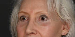 Blepharoplasty Before & After Gallery - Patient 618067 - Image 2