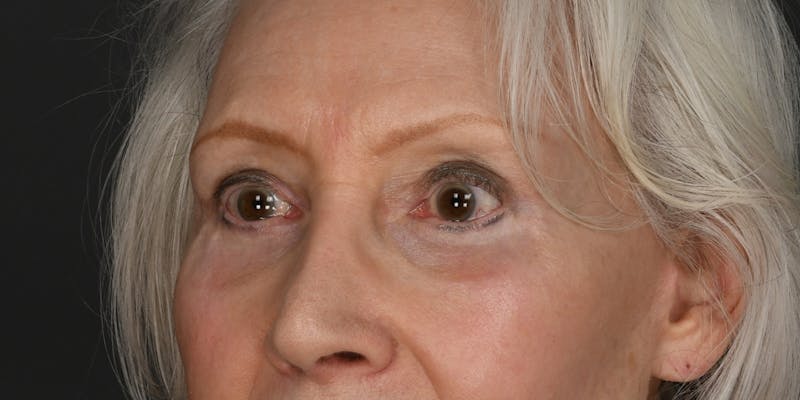 Blepharoplasty Before & After Gallery - Patient 618067 - Image 2
