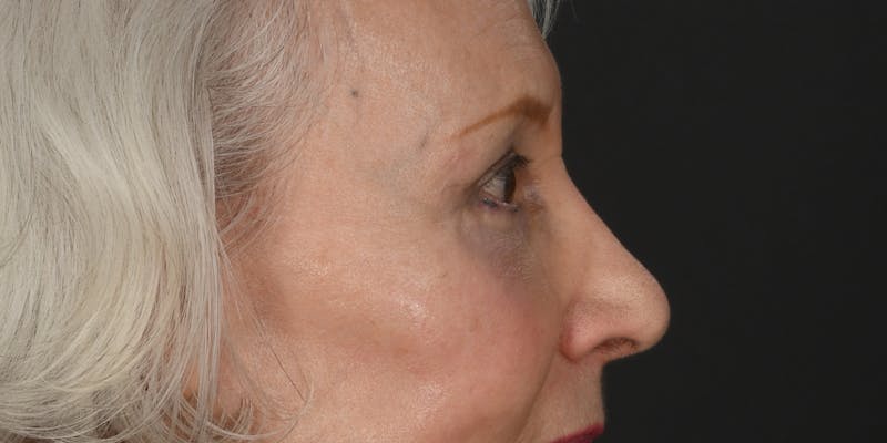 Blepharoplasty Before & After Gallery - Patient 618067 - Image 6