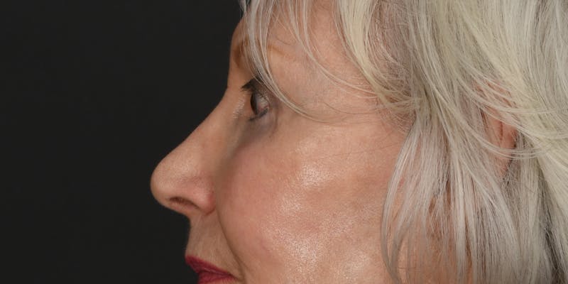 Blepharoplasty Before & After Gallery - Patient 618067 - Image 4
