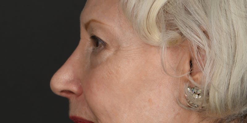 Blepharoplasty Before & After Gallery - Patient 618067 - Image 3