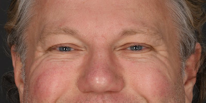 Blepharoplasty Before & After Gallery - Patient 713572 - Image 1