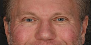 Blepharoplasty Before & After Gallery - Patient 713572 - Image 2