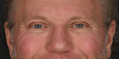 Blepharoplasty Before & After Gallery - Patient 713572 - Image 2