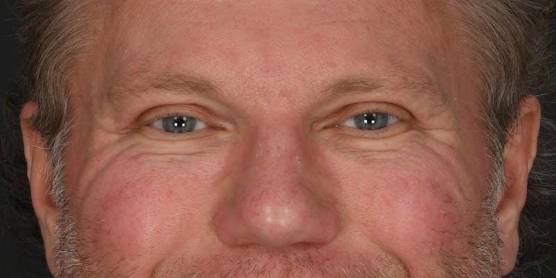 Blepharoplasty Before & After Gallery - Patient 713572 - Image 2