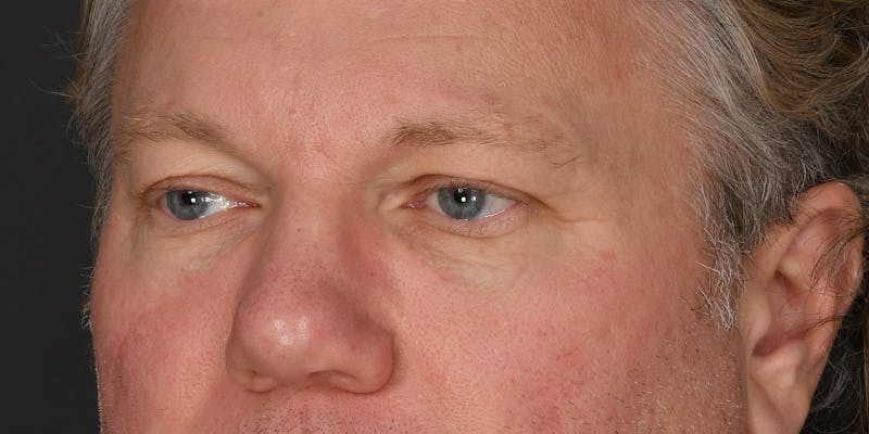 Blepharoplasty Before & After Gallery - Patient 713572 - Image 3