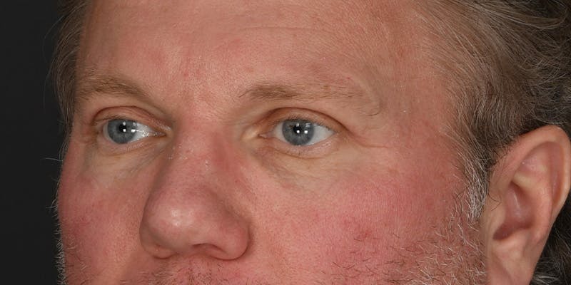 Blepharoplasty Before & After Gallery - Patient 713572 - Image 4