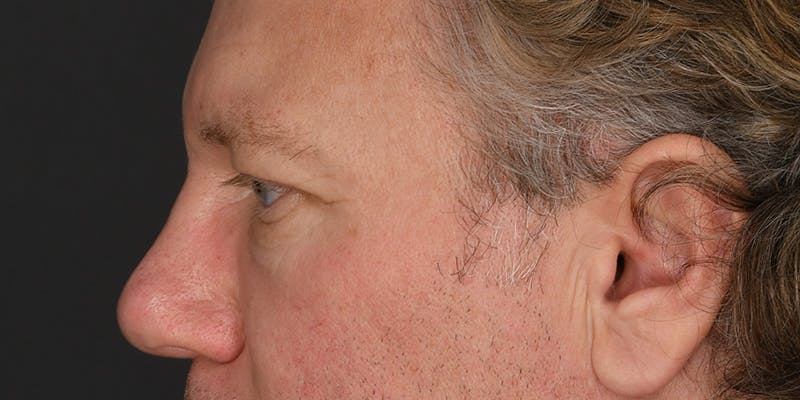 Blepharoplasty Before & After Gallery - Patient 713572 - Image 5